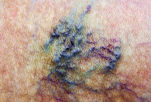 Varicose and Spider Veins