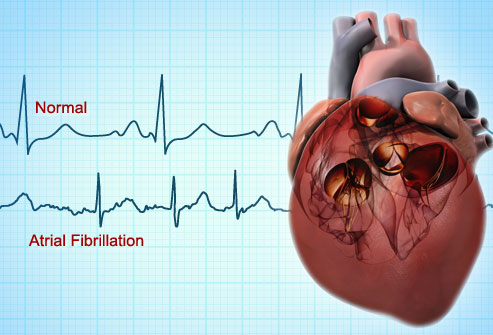 A Guide to Atrial Fibrillation