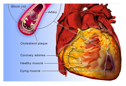 What is Heart Attack