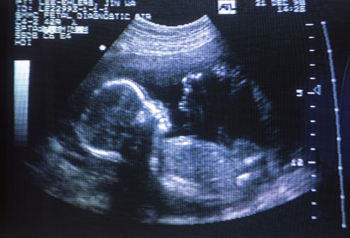 Schizophrenia and Pregnancy