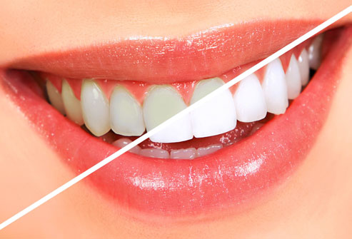 Tips for Brighter Teeth