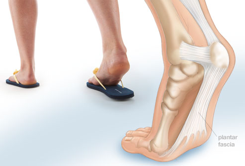 Complication: Plantar Fasciitis
