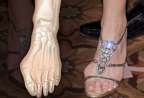 Complication: Bunions