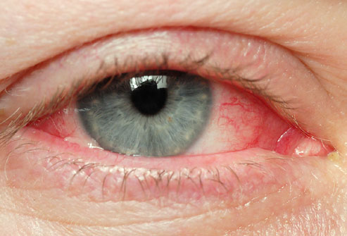 Symptom: Eye Redness