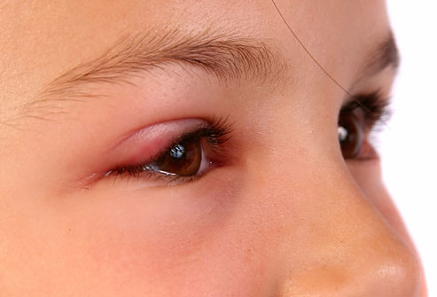 Symptom: Swollen, Red Eyelids