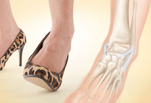 Complication: Sprains in Ankle