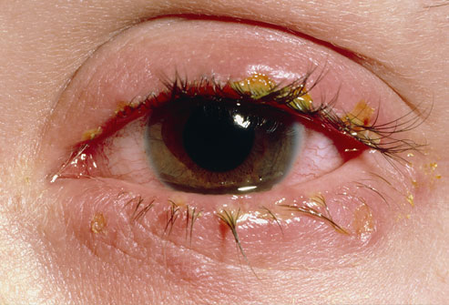 Symptom: Crusty Eyelids