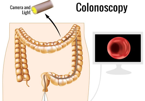 Colon Cancer Detect