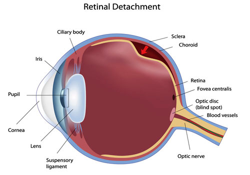 Facts about Retinal Detachment