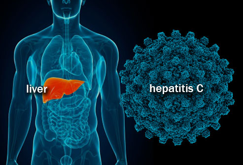 What you need to know about Hepatitis C