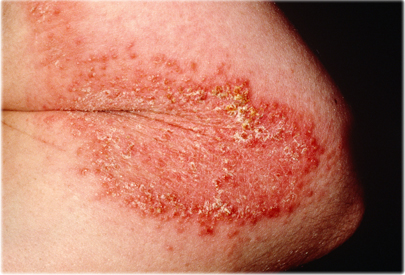 A poison ivy rash will spread if scratched