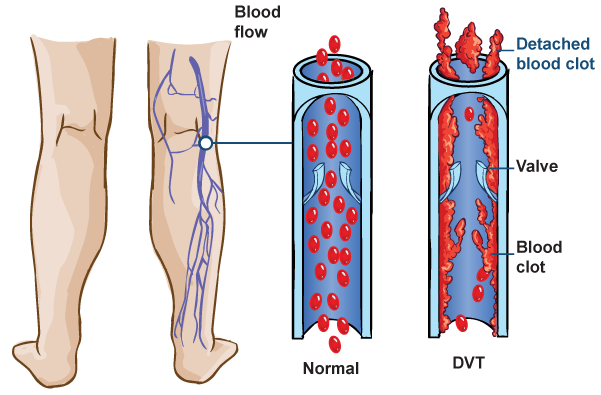 An Overview on Deep Vein Thrombosis (DVT)