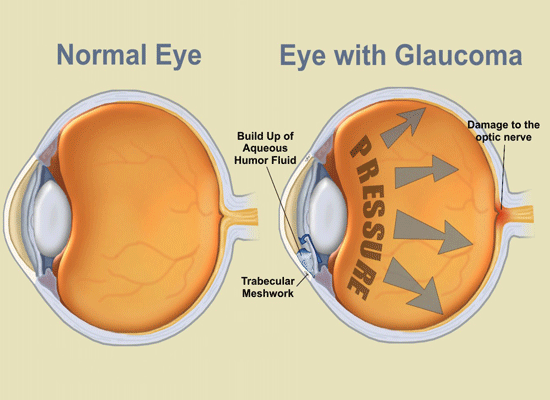 Glaucoma - A Complete Guide