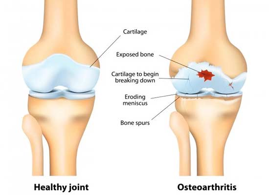 the-common-causes-of-severe-knee-pain