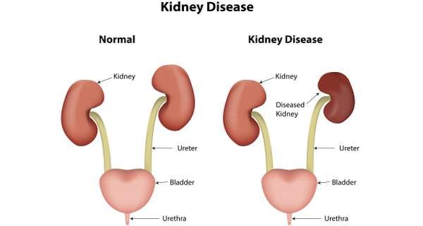Health Conditions That Affect Your Kidneys - Medical Tourism in India | Top  Health Tourism Companies India