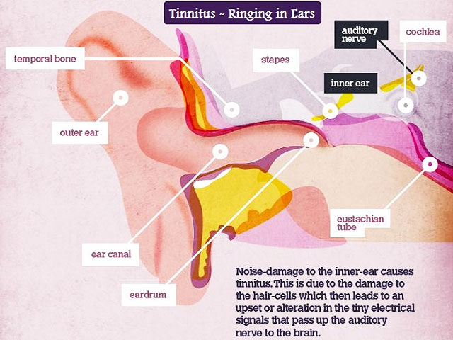 Neuroinflammation and tinnitus in COVID-19 vaccine recipients