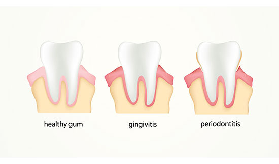 10-Silent-Signs-Of-Gum-Disease-You-Must-Never-Ignore