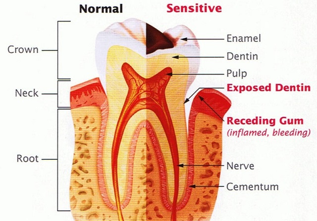 causes sensitive tooth
