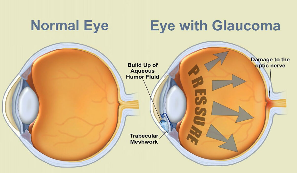 World Glaucoma Week – Understanding Glaucoma
