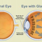 World Glaucoma Week – Understanding Glaucoma