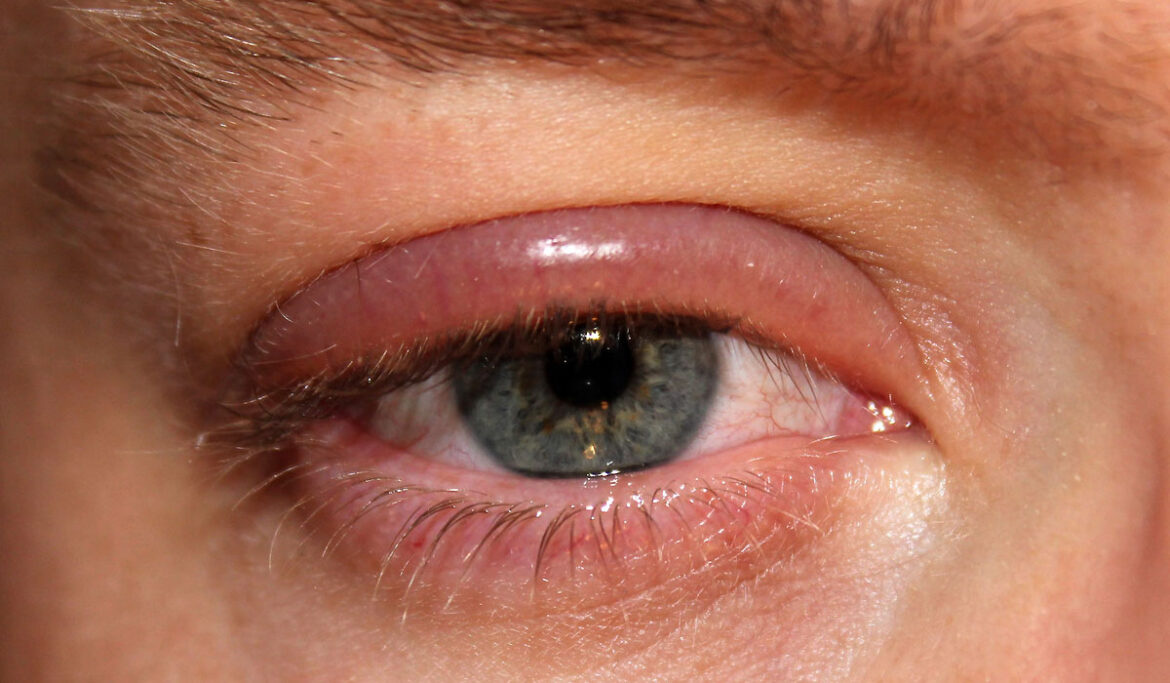 Different Types of Pediatric Eye Disorders