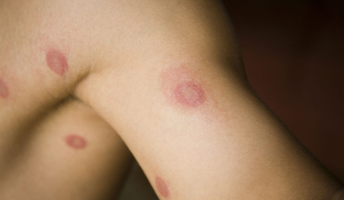 a-complete-guide-on-ringworm