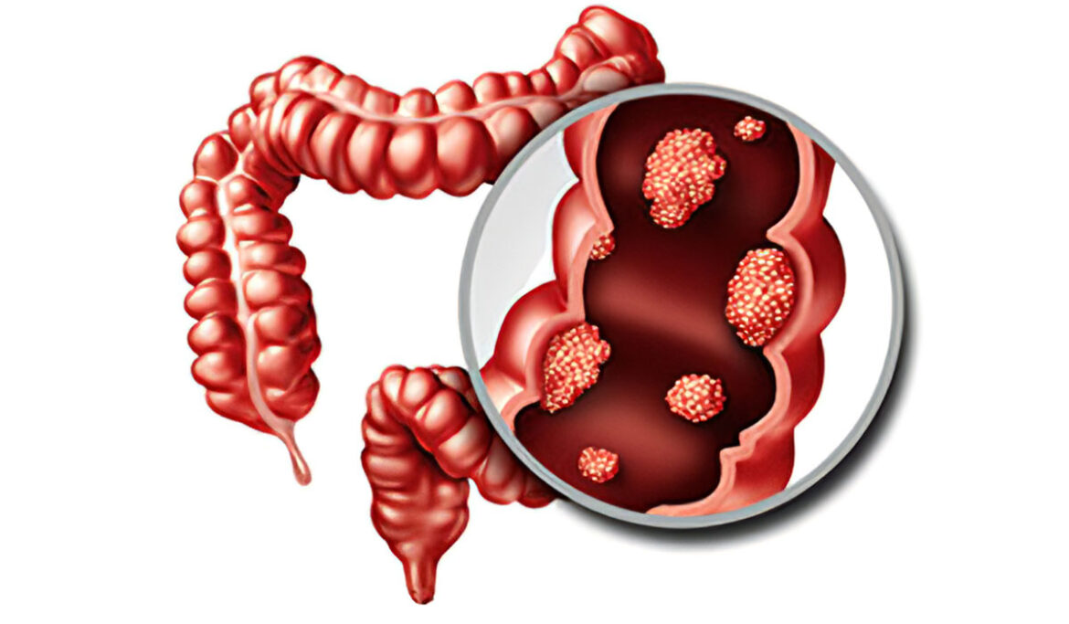 colon-cancer