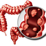 What You Need to Know about Colon Cancer