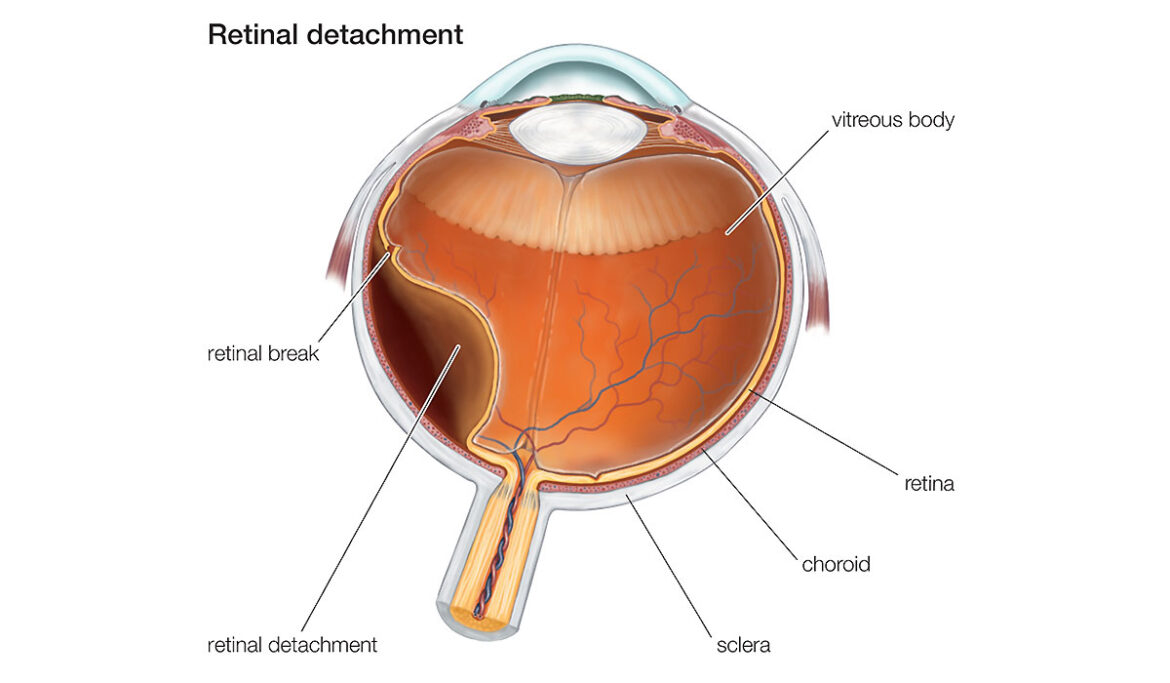 facts-about-retinal-detachment
