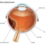 Facts about Retinal Detachment