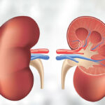 Kidney Failure: Stages and Treatments