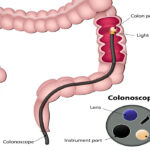 Venkateshwar Platinum Health Checkup With Colonoscopy