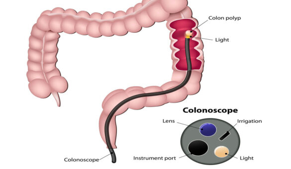 Platinum Health Checkup With Colonoscopy