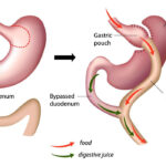Gastric Bypass Surgery in India