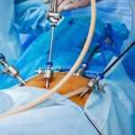 Laparoscopic Sleeve Gastrectomy in India