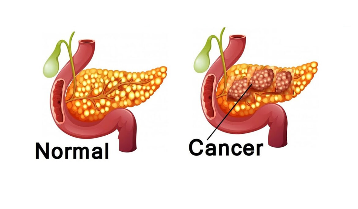 banner-pancreatic-cancer