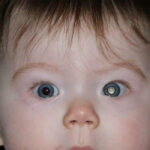 Retinoblastoma (Eye Cancer) Treatment in India