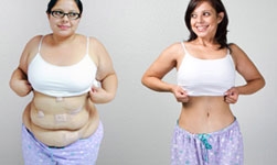 Bariatric Surgery Cost in India