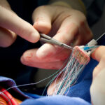 Heart Valve Replacement Surgery in India
