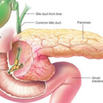 Gall Bladder Surgery in India