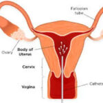 IUI(Artificial Insemination) in India