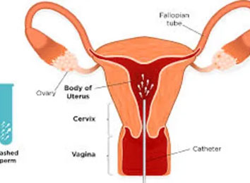 icon_138_4796 IUI-(Artificial-Insemination)
