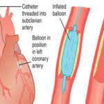 Coronary Angioplasty in India