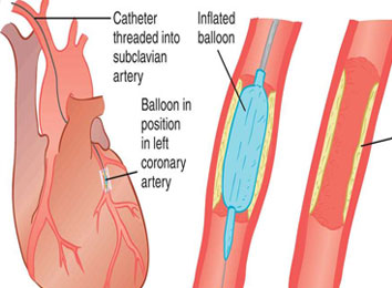 coronary-angioplasty
