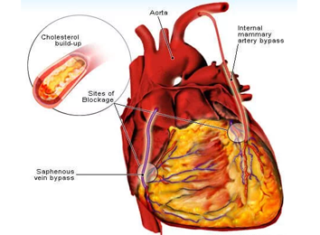 coronary-artery-bypass