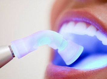 laser-dental-treatments