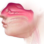 Nasal Polyps Treatment in India