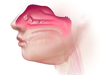 icon_280_1829 nasal-polyps-treatment-in-india