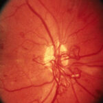 Diabetic Retinopathy in India