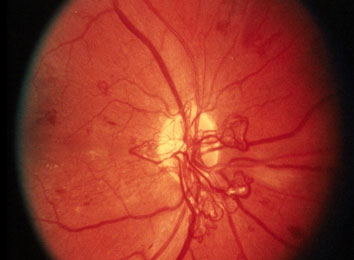 diabetic-retinopathy